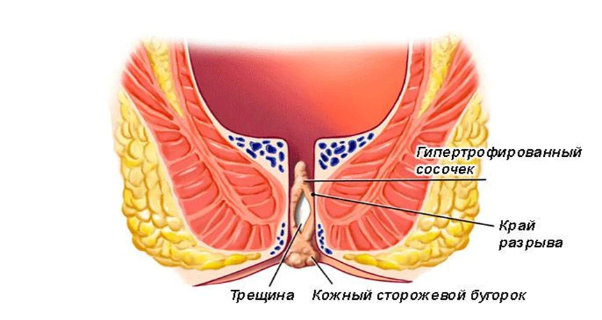 Анальная трещина (трещина прямой кишки): симптомы, последствия, методы лечения