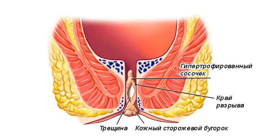 Анальная трещина: симптомы, лечение, профилактика