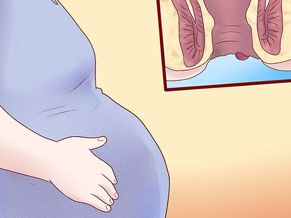 Лечение геморроя при беременности и после родов.jpg